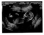 What To Expect On Dating Scan / Dating Scans Ultrasound Services - I'm worried about potential miscarriage and also confused about the due date changing?