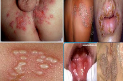 Cara Menghilangkan Virus Herpes Zoster