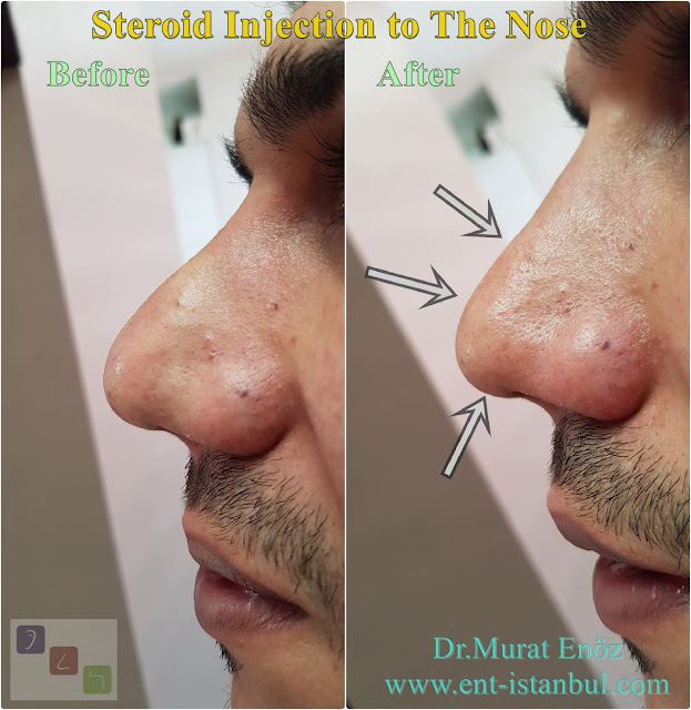 Steroid injection after rhinoplasty