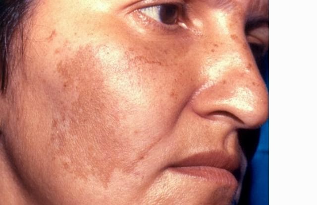 Melasma Treatments: October 2013