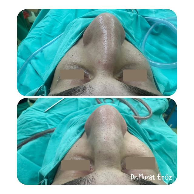 Closed technique, nasal fracture, reduction, general anesthesia, closed reduction, nasal bones, nasal trauma, nasal realignment, closed reduction procedure, post-operative care, recovery, anesthesia administration, nasal manipulation, alignment confirmation