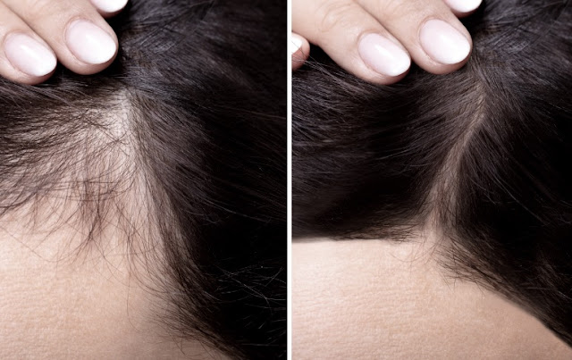 natural hair loss treatments that work