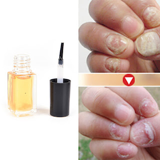 topical antifungal medications for nails