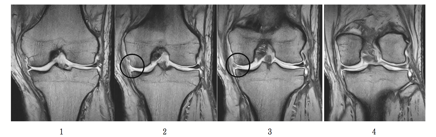 整形外科リハビリテーション学会京都支部スタッフブログ 文献紹介 内側半月中後節移行部横断裂のmri所見