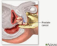 cancer prostat,cancer de la prostat,prostat cancer,la prostate cancer,cancer,de la prostate cancer,comment diagnostiquer un cancer,diagnostiquer un cancer,diagnostique cancer