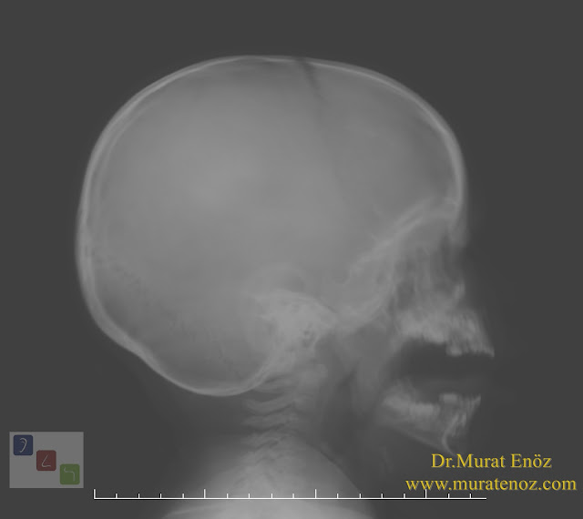 The Effects of Enlarged Adenoids on Dentofacial Developments - Adenoid Hypertrophy and Its Negative Health Effects Depending on the adenoid hypertrophy in children, the following changes may occur in the jaw and tooth structure - The Mouth Breathing Syndrome (MBS) - How to Evaluate the Size of The Adenoid? - Adenoid graphy (lateral cephalometic radiograph) - How should the lateral cephalometic radiograph be? - How Should Treatment Be Berformed in Patients With Changes in The Jaw and Tooth Structure Due to Adenoid Hypertrophy? - When Does Adenoid Growth Stop Spontaneously? - Don't Wait To Structural Change For Treatment of Severe Adenoid Hypertrophy!