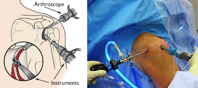 What is Shoulder Arthroscopy?