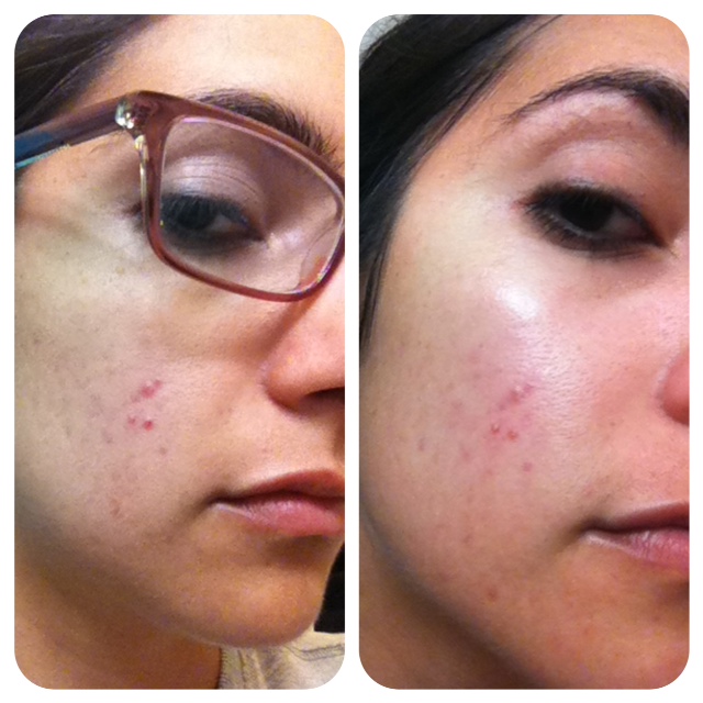 clarisonic before and after