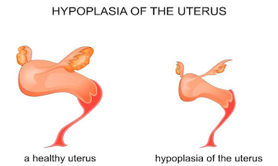 Prolapsed Uterus, Uterine prolapse