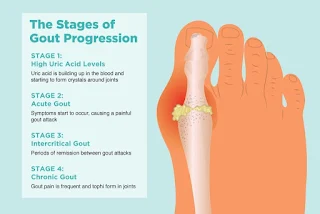 Stages of Gout Progression