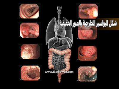 شكل البواسير الخارجية بالصور الحقيقية