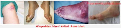 obat asam urat bikin sendiri