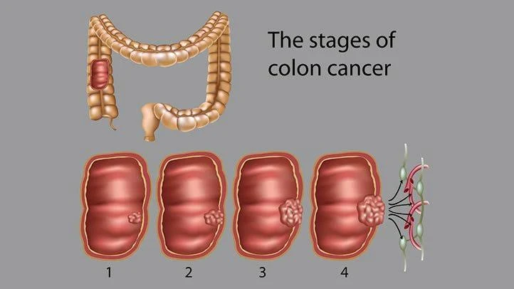 4 Stages of Colon cancer