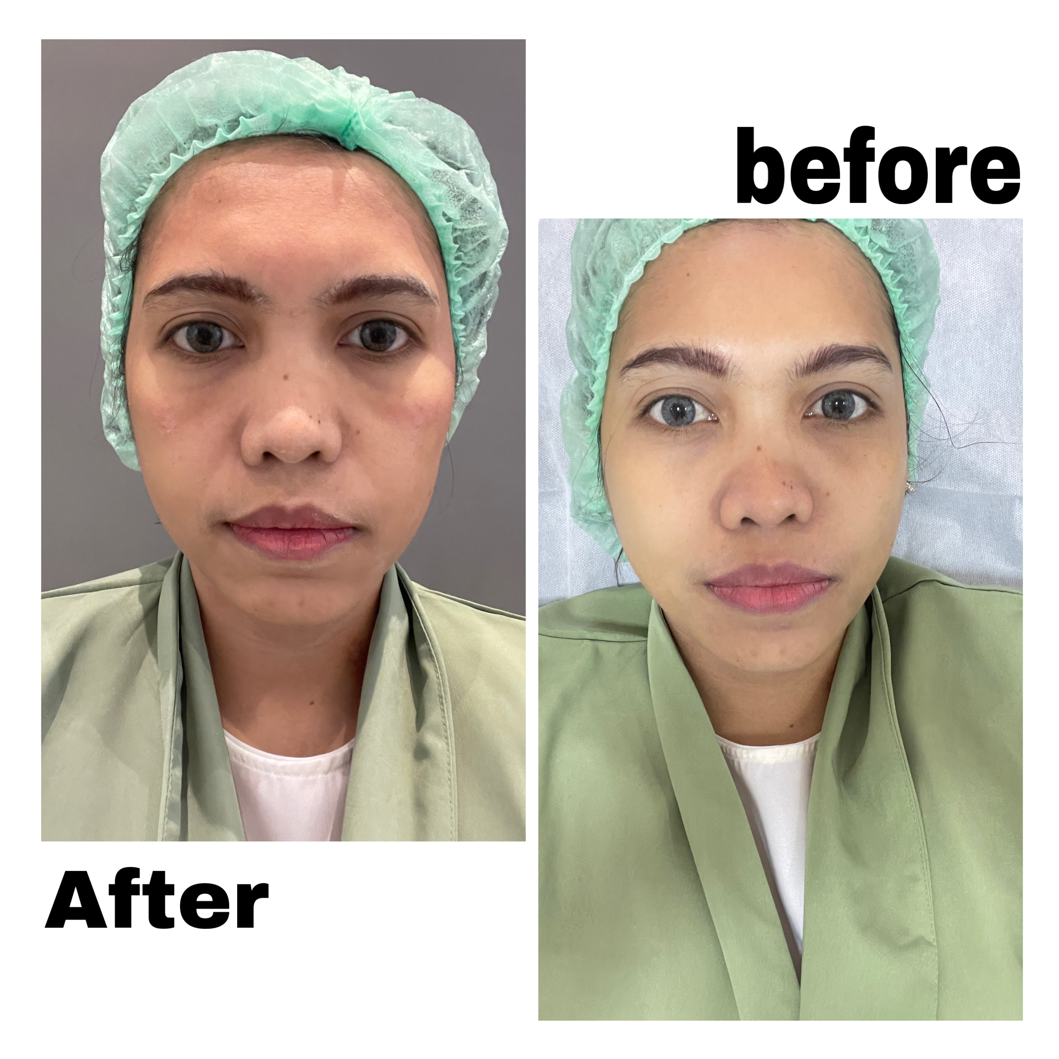 Pengalaman Filler Under Eyes yang Gagal dan Malah Bikin Tambah Tua