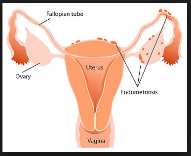 Pengertian Penyakit Endometriosis, Gejala, Penyebab dan Pengobatan