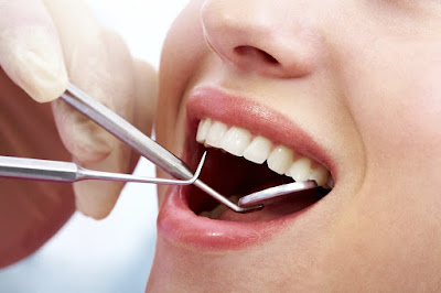 Có nên tẩy trắng răng không? Các phương pháp tẩy trắng răng phổ biến-4