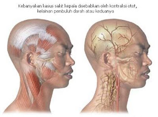 Apa yang dimaksud dengan MIGRAIN Mekanisme serta TIPS 