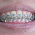 Meratakan Gigi (Orthodontic)