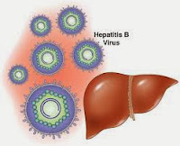 Cara mengobati hepatitis B