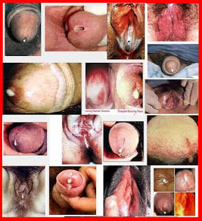 Obat gonorrhea kencing nanah, cara mengobati gejala sipilis, larangan kencing nanah, akibat terkena penyakit kencing nanah, obat gonore (kemaluan bernanah) jakarta
