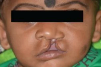 Cleft lip