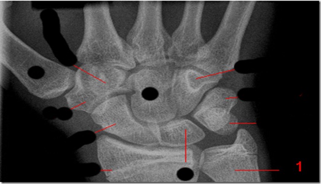 radiografia-polso