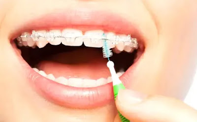 Que sont les appareils dentaires invisibles ?