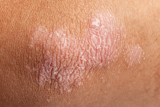 Tratamientos Naturales Para La Psoriasis