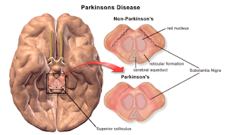 Parkinson's Disease: Symptoms, Causes, Prevention, Treatment