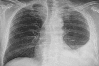 Pleural Mesothelioma