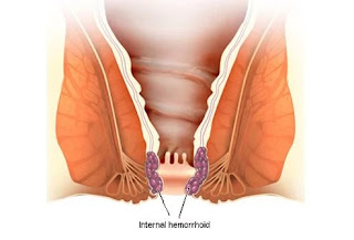 Internal Hemorrhoid