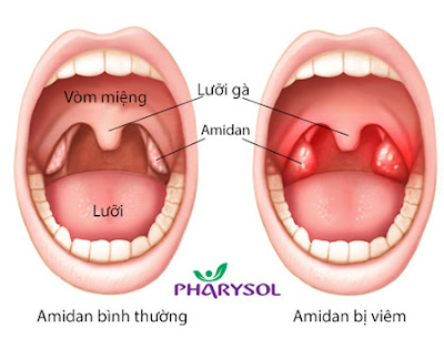 Viêm Amidan Có Nên Cắt Không ?