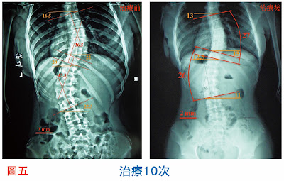 脊椎側彎, 脊椎側彎背架, 脊椎度數,脊椎側彎矯正, 脊椎側彎治療, 脊椎側彎 復健