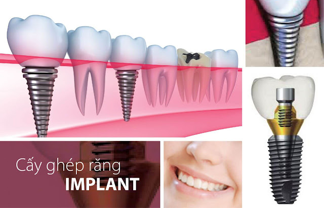 Cấy ghép implant đang là lựa chọn tốt nhất để phục hình lại những răng đã mất