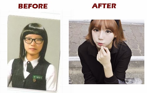 Korean Plastic Surgery Before After