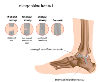 Ankle sprain treatments, diagnosis and symptoms in children and adolescents