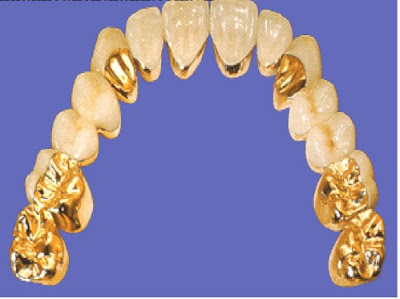 Răng sứ Cercon có ưu điểm gì?