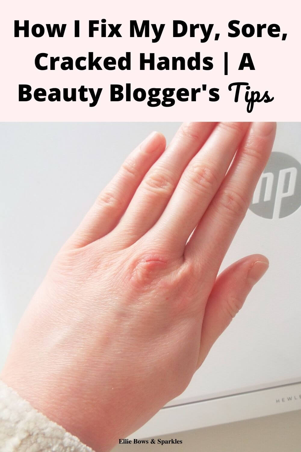 Pinterest pin, featuring picture of dry, sore, cracked hands. There's a pink title card to the top and bold black font, reading "How I Fix My Dry, Sore, Cracked Hands | A Beauty Blogger's Tips".