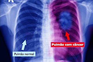  câncer de pulmão, tumor no pulmão tempo de vida, cancro do pulmão tem cura, sintomas cancro pulmao dor nas costas, cancro do pulmão fase terminal sintomas, cancro do pulmão imagens, dor no pulmão nas costas, sintomas cancro garganta, cancro do pulmão causas