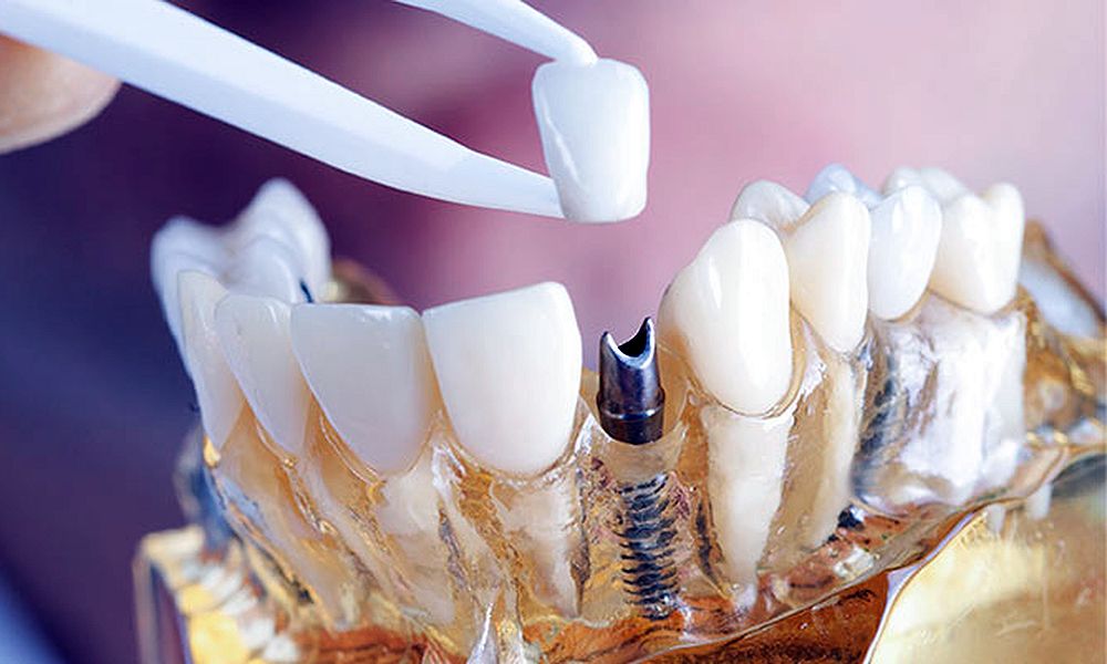 Dental Implants