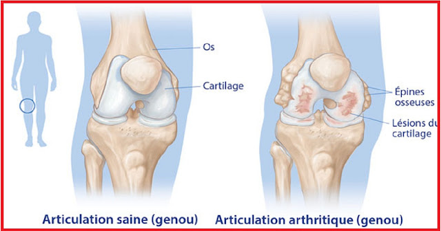 arthrite-image