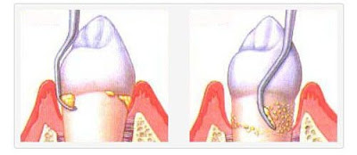 Cách điều trị viêm chân răng có mủ an toàn-2