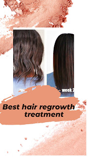 best hair regrowth treatment