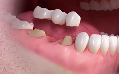 Trồng răng giả mất bao lâu với cầu răng sứ? 2