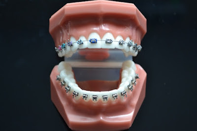 Có mấy giai đoạn niềng răng hô?