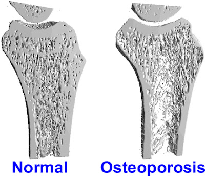 Ways to strengthen bones