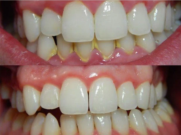 Say goodbye to caries, tartar and yellow teeth with this recipe