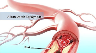 cara mengatasi aliran darah tersumbat