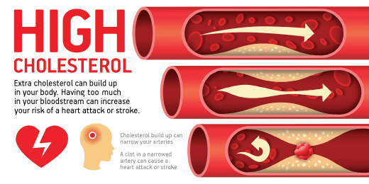 Kolesterol : Antara mitos dan realiti.