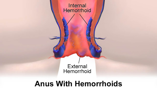 WHAT IS PILES? DIFFERENCE BETWEEN PILES AND HAEMORRHOIDS?  TYPES, HOW DO PILES START? CAUSES.SYMPTOMS, DIAGNOSIS . TREATMENT